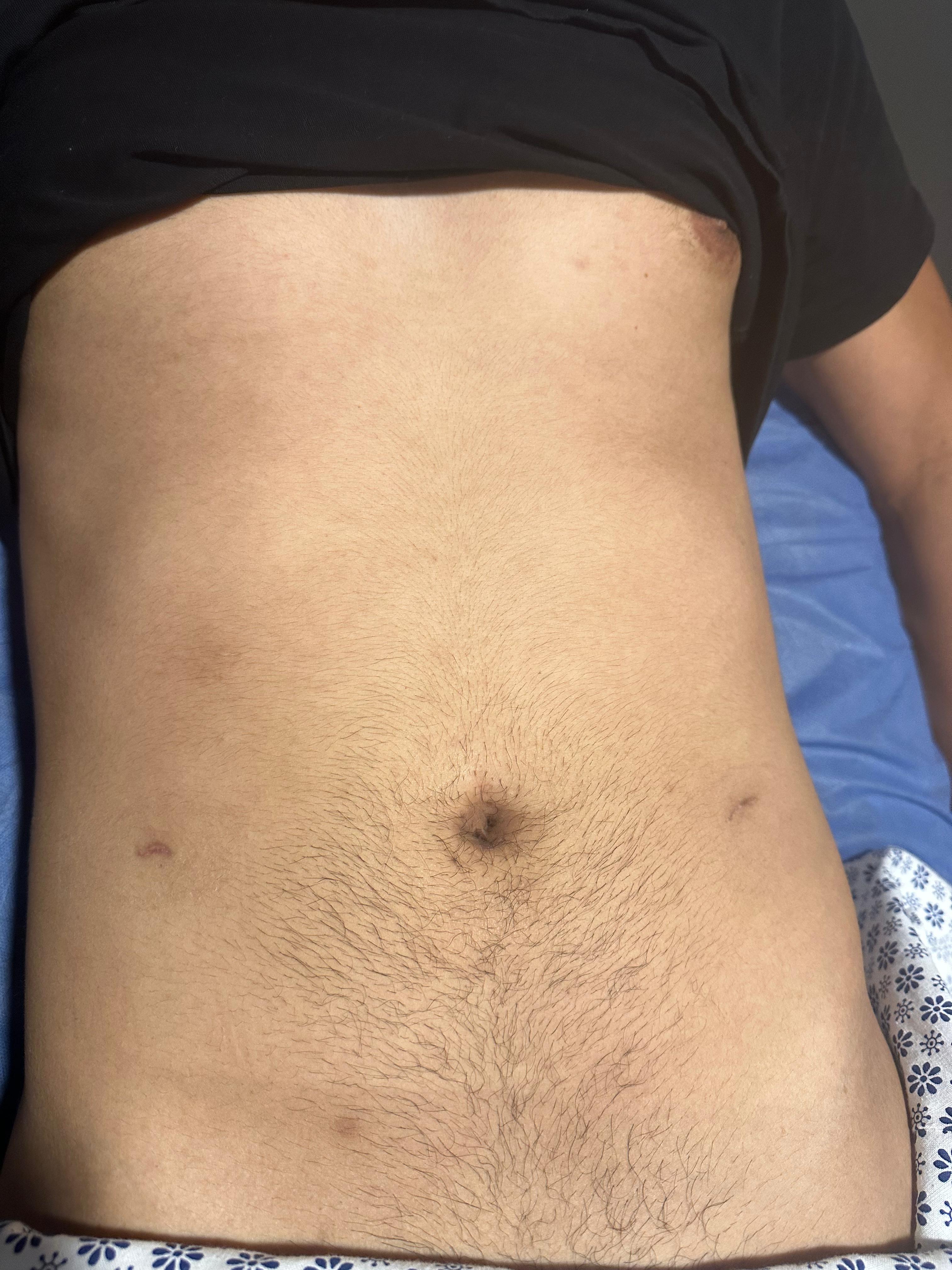 Resultado de cirugía de hernia inguinal sin huella
