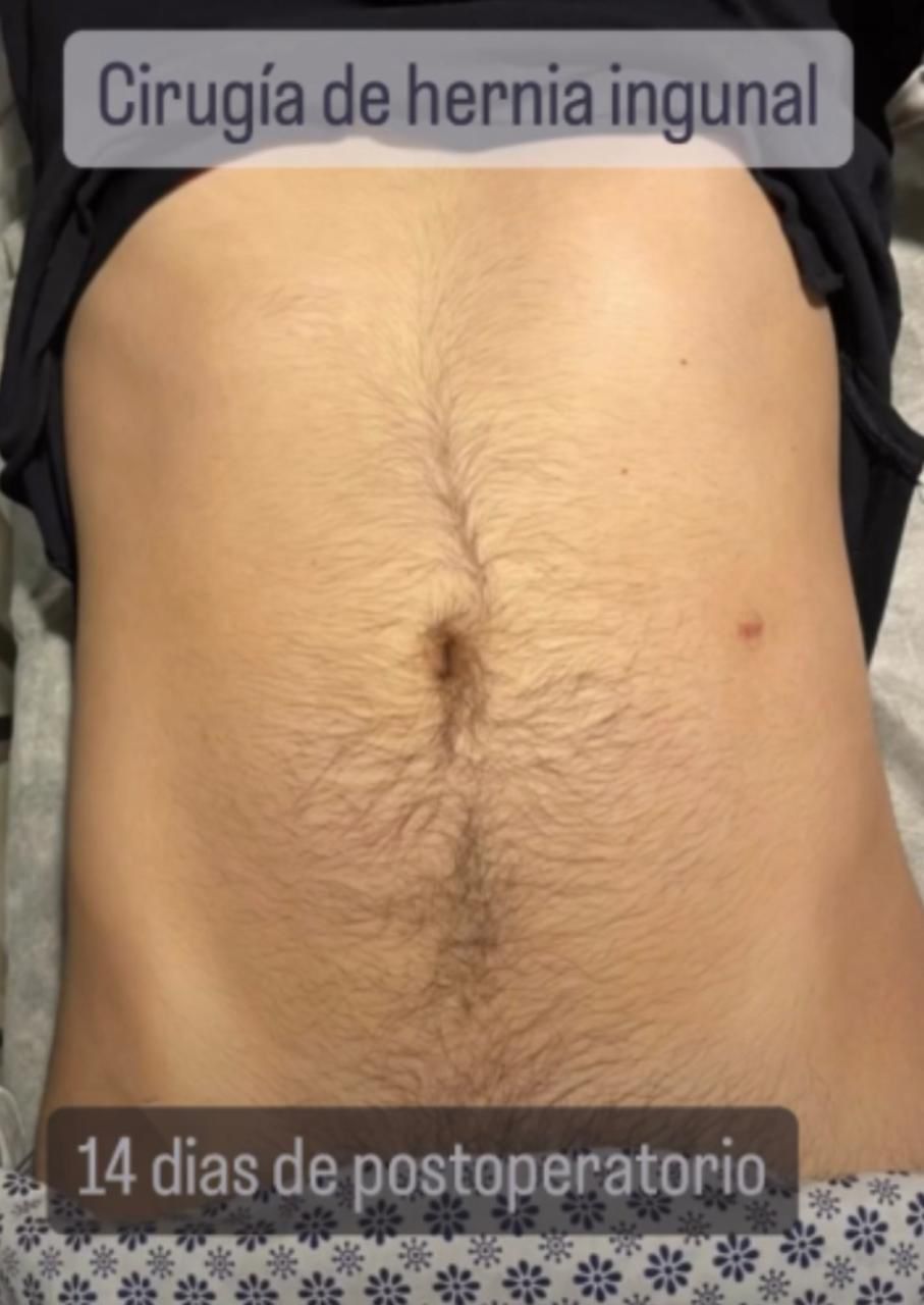 Resultado de cirugía de hernia inguinal sin huella