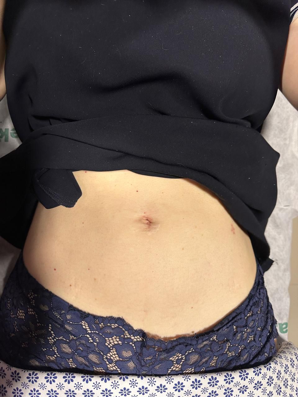 Resultado de cirugía de hernia inguinal sin huella