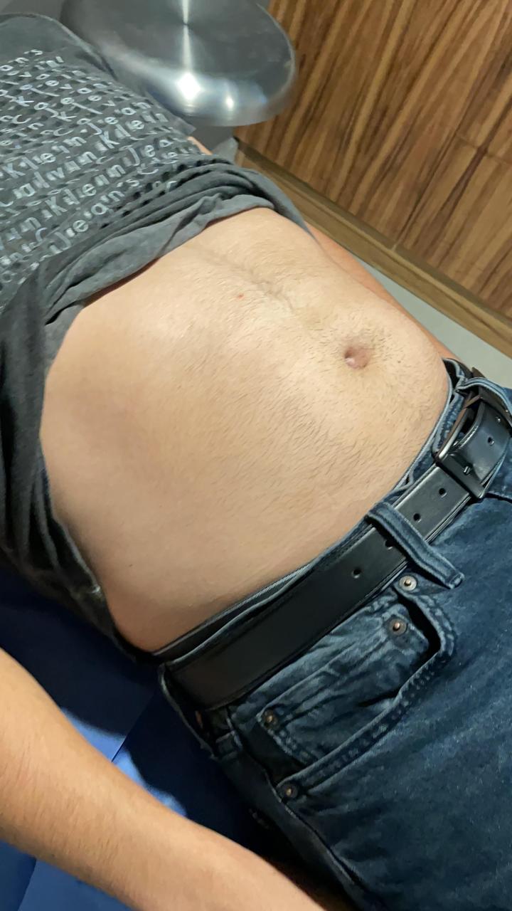 Después · Hernia umbilical corregida