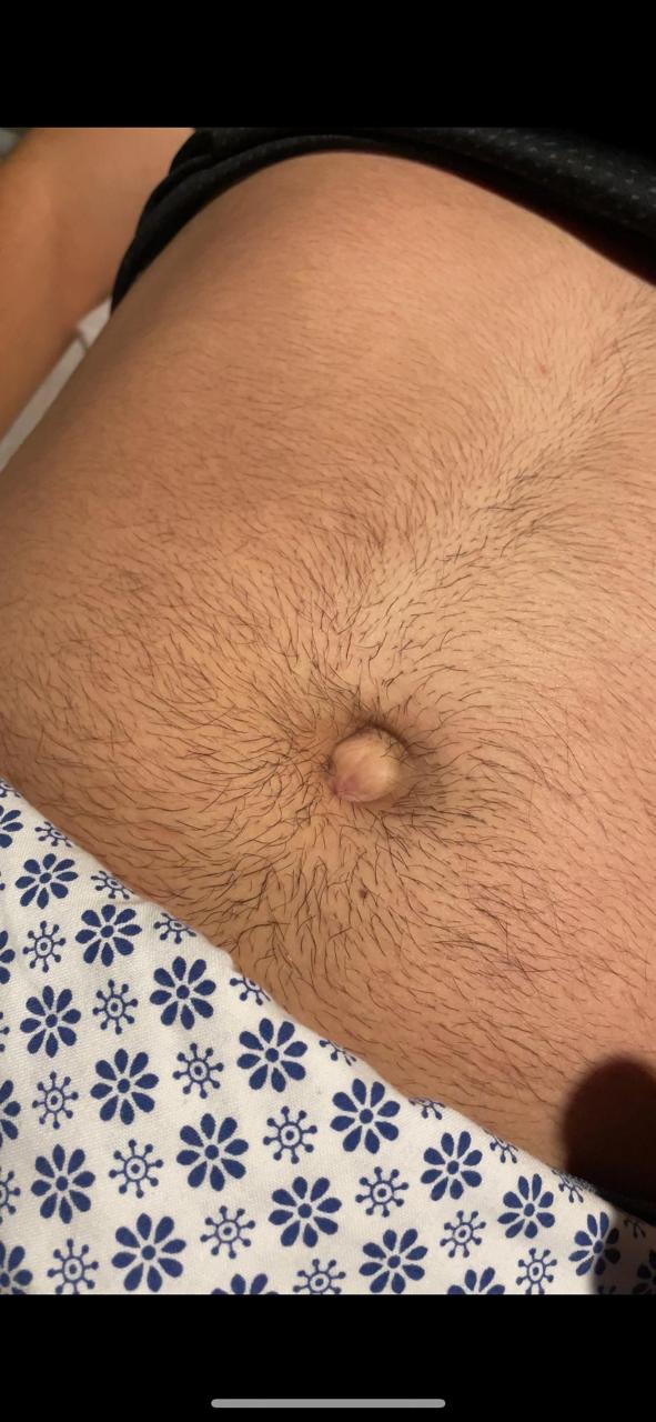 Antes · Hernia umbilical visible