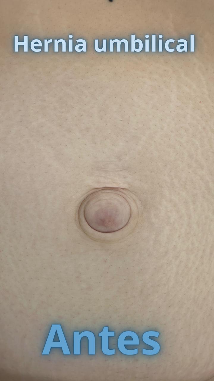 Antes · Defecto umbilical previo