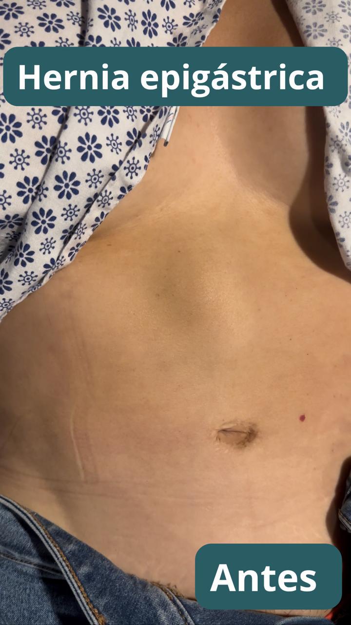 Antes · Hernia epigástrica visible