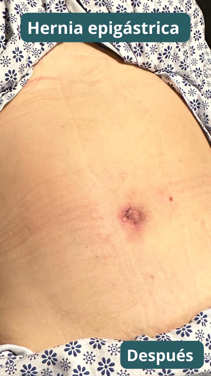 Después · Hernia epigástrica reparada