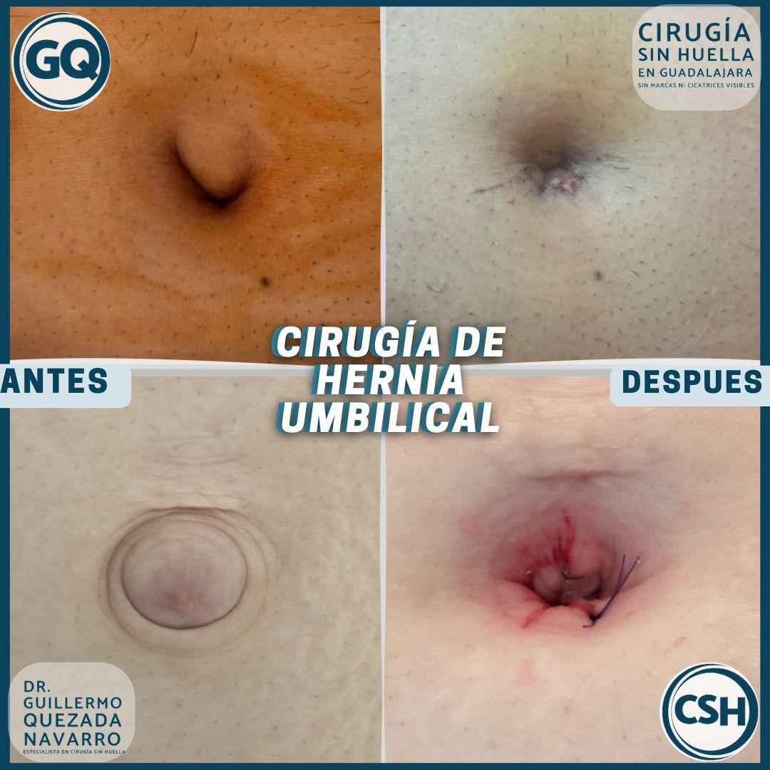 Comparativo · Hernia umbilical, antes y después